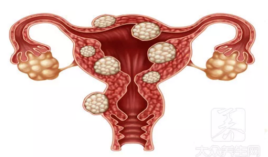 天津津南敖漢旗子宮肌瘤多大需要做手術(shù)治療